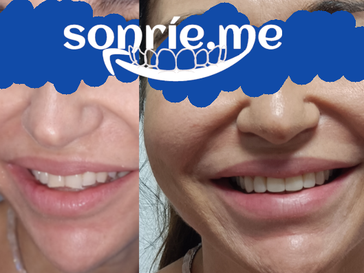 Raquel: dientes desgastados, rotados y afilados