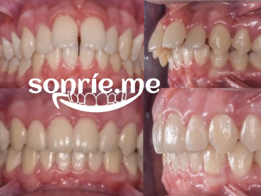 Juan: clase II, resalte aumentado, distemas